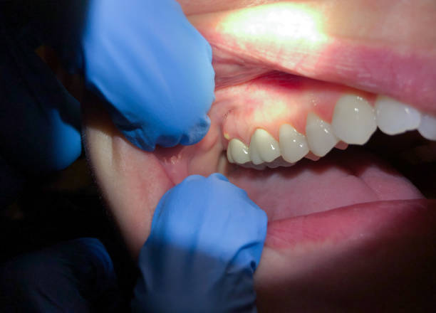 Best Chipped Tooth Repair Near Me  in Elmore, OH
